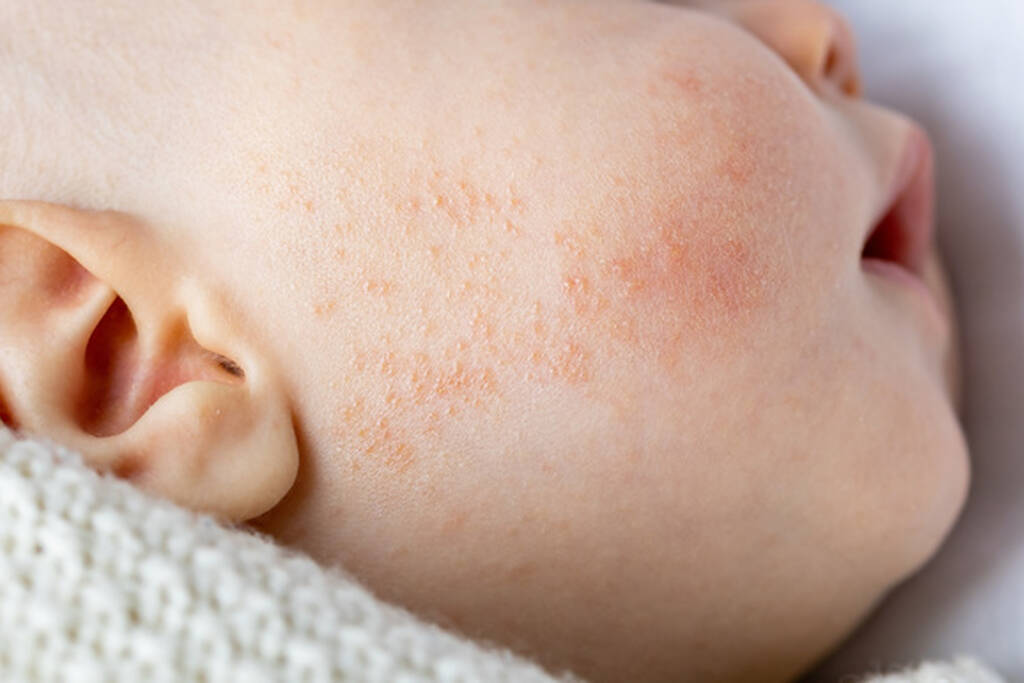 Traiter l’Eczéma de Bébé Pendant le Bain : Solutions et Précautions
